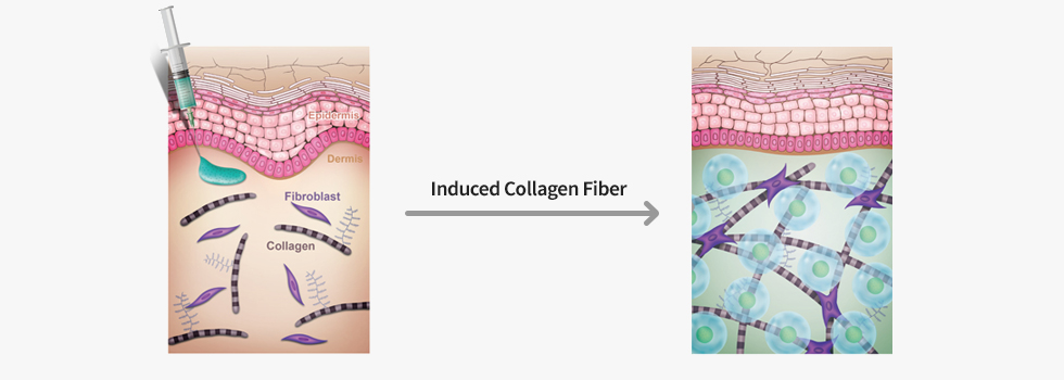 Induced Collagen Fiber